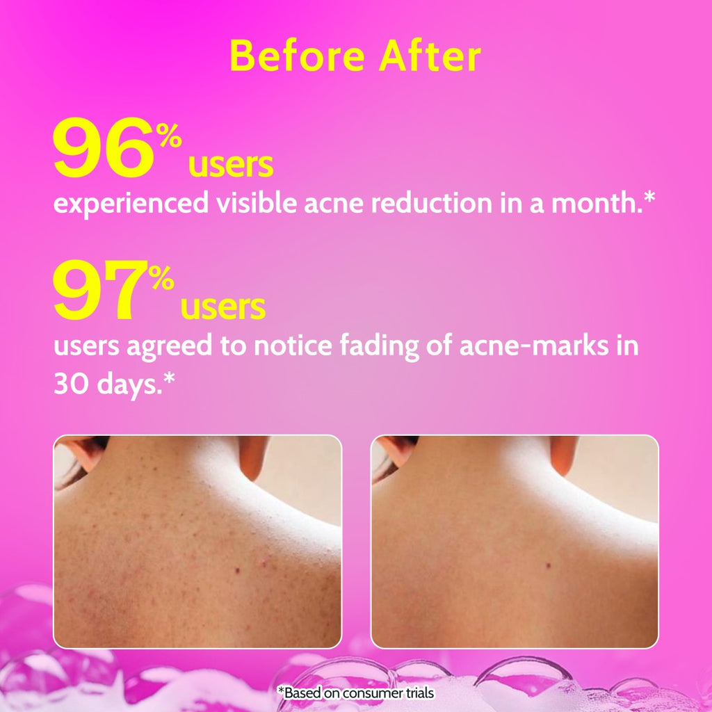 1% Salicylic Acid Body Wash for Acne Control (236 ml) with Loofah
