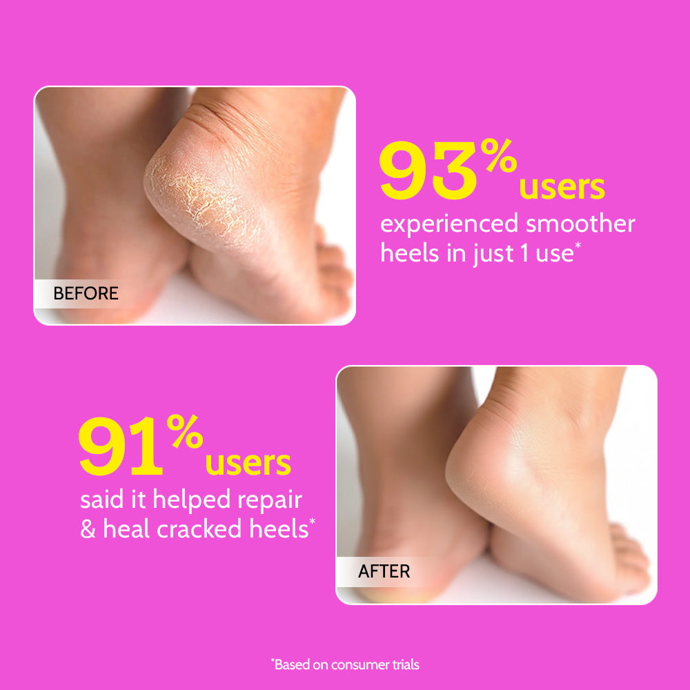 Foot Roll-on for Cracked Heels & Diabetic Foot - 50 gm | Pack of 3