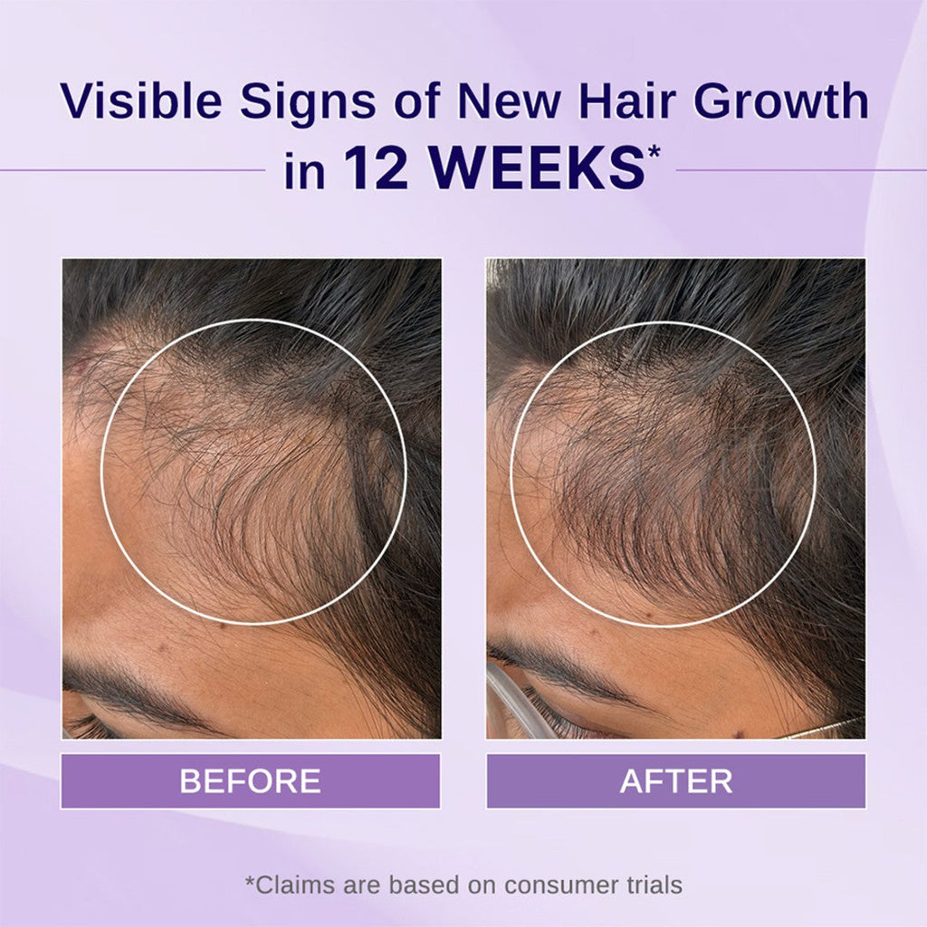 Rosemary & Hibiscus Hair Growth Oil - 100 ml | Pack of 3