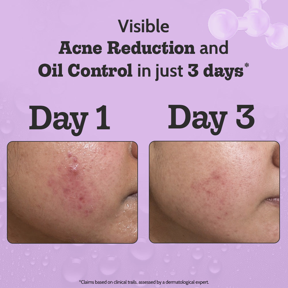 2% Salicylic Acid Face Serum for Acne Control - 30 ml